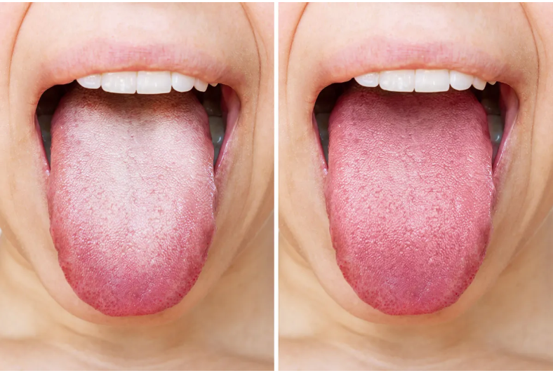 If you have a white tongue, it means that your… See more in first comment